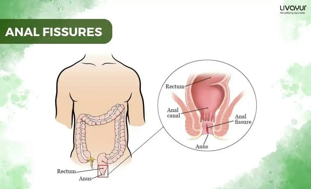 Anal Fissure Symptoms Causes Treatment Prevention