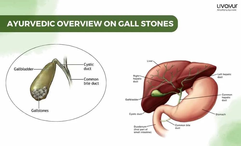 Gallstones Symptoms Causes Diagnosis Treatment More 1 9 11zon