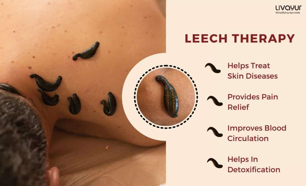 Leech Therapy What it is Benefits Side Effects How its Done 1