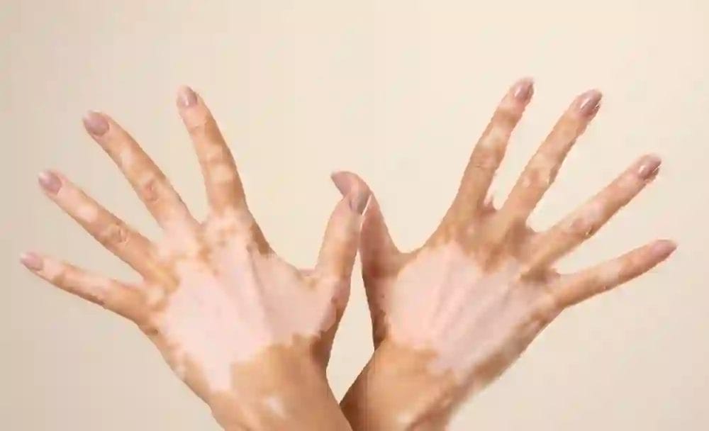 vitiligo - livayur
