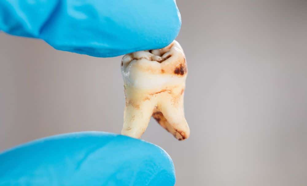 tooth decay - livayur