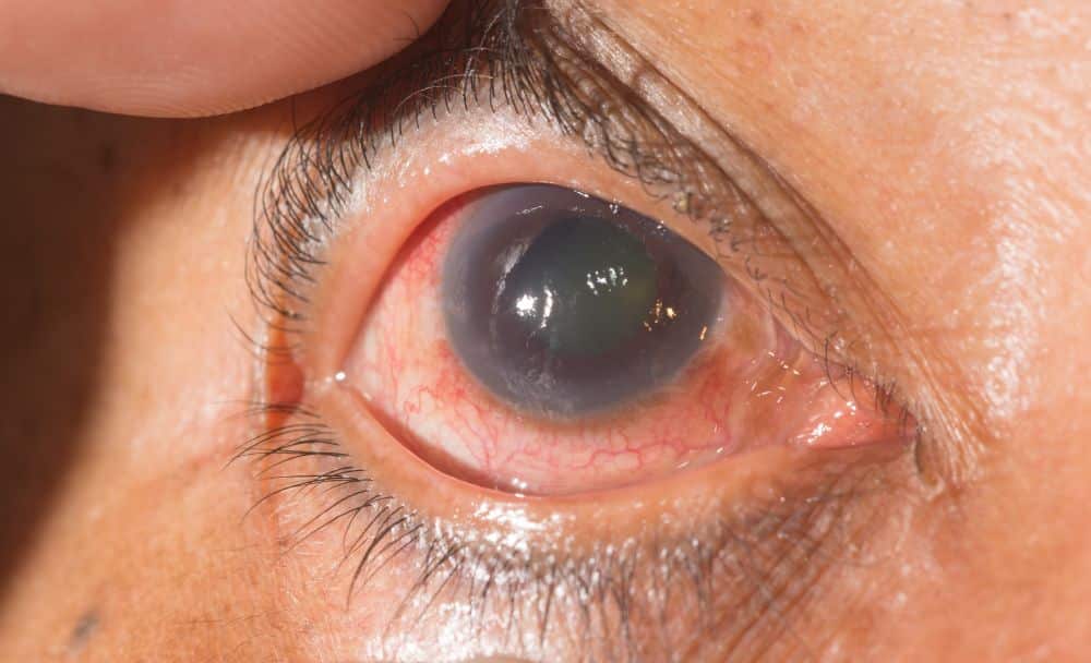 glaucoma - livayur