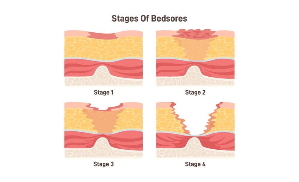 stages of bed sores