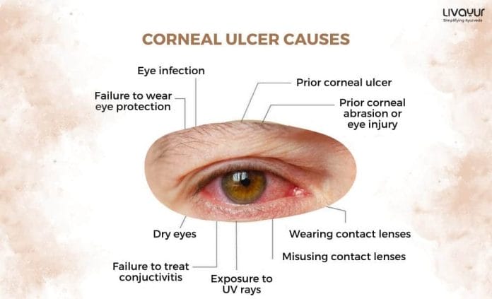 Corneal Ulcer What Is It Causes Symptoms Treatment 1