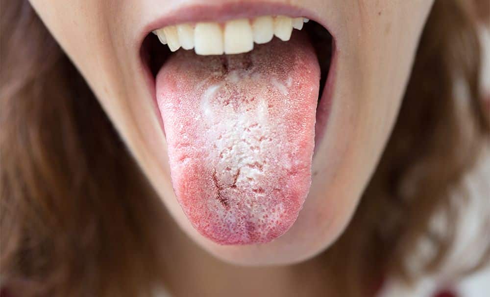 tongue infection - livayur