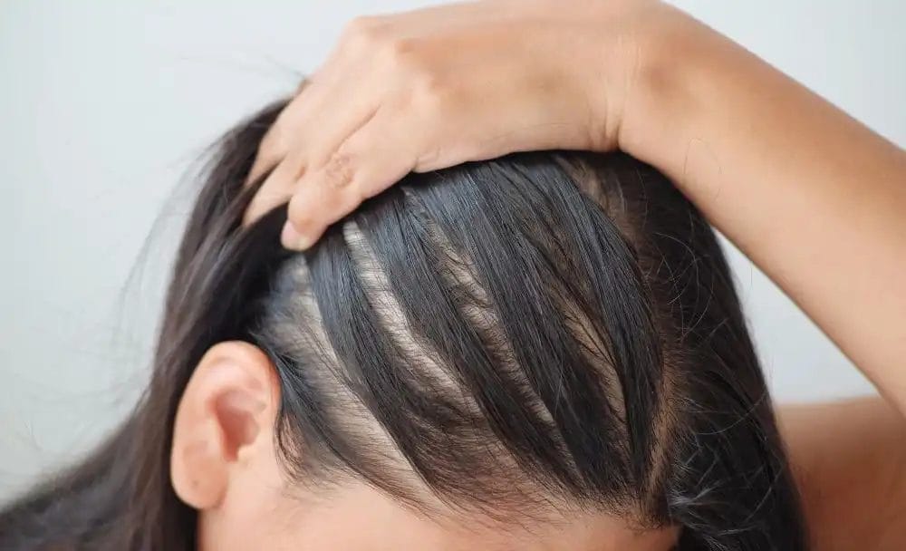 Hair fall Treatment