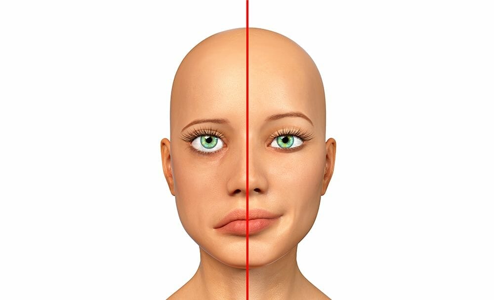  bell's palsy treatment
