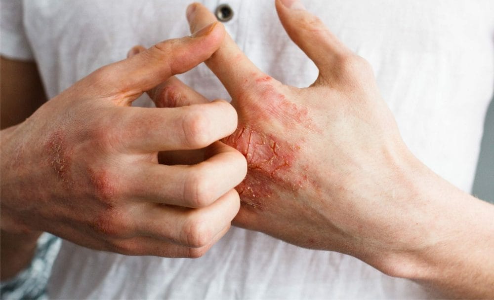symptoms of contact dermatitis