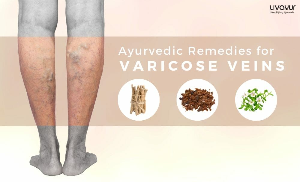 ayurvedic treatment for varicose veins