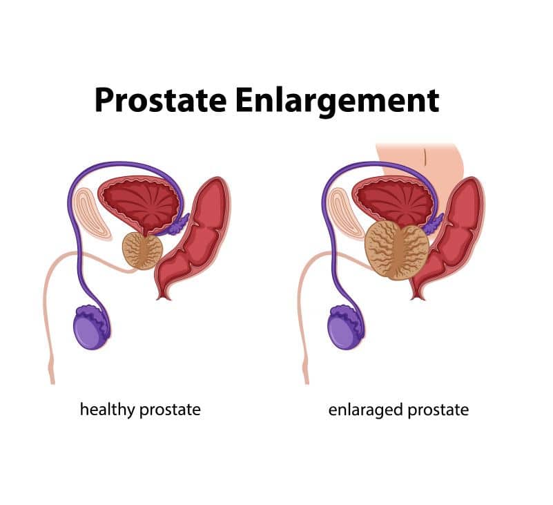 Prostatomegaly: Symptoms, Stages Causes, Diagnosis, Treatment