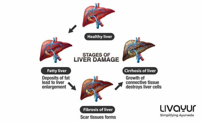 liver cirrhosis diet chart