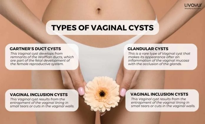 vaginal cyst - livayur